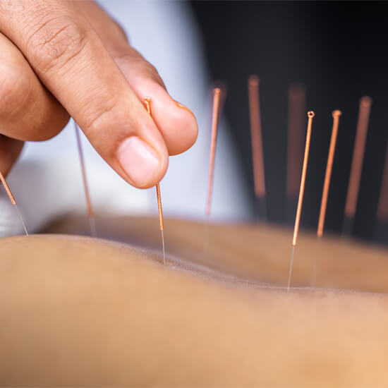 foto-acupuntura2